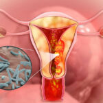 Female genital tuberculosis symptoms, diagnosis, and treatment overview