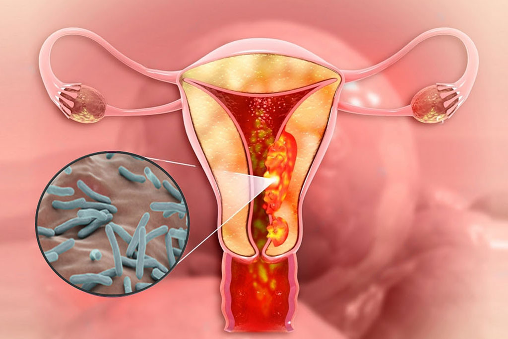 Female genital tuberculosis symptoms, diagnosis, and treatment overview